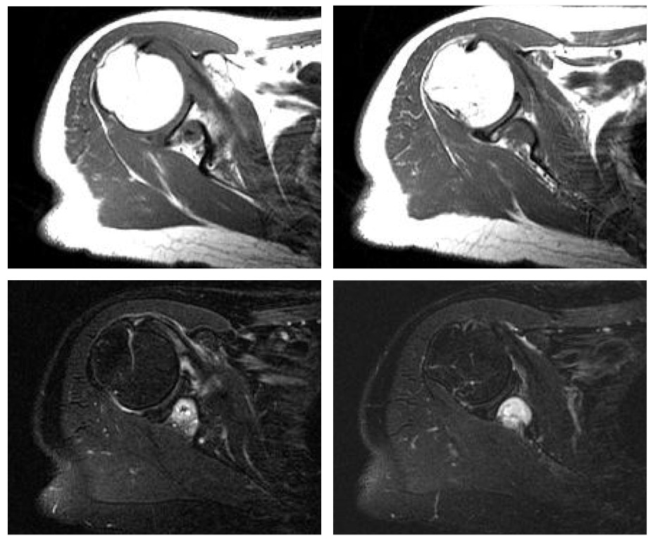 Figure 2 for case inflammatory pseudotumor ( RID3860 )